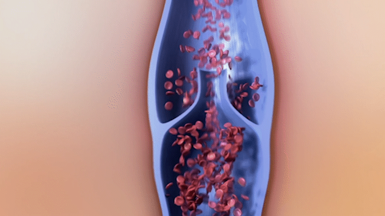 Ilustraţie cu insuficienţă venoasă, în care se poate vedea compresia anormală a venelor şi continuarea pierderii elasticităţii, care împiedică circulaţia sângelui
